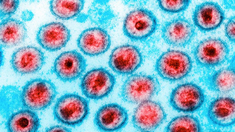 Réponse virologique solide aux TAR classiques après infection sous PrEP injectable CAB-LA