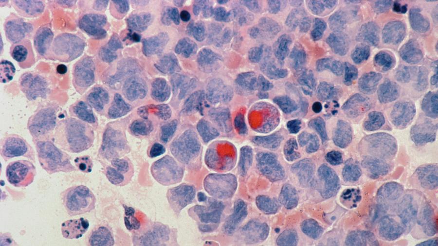 Cancer du sein HER2 positif: une bithérapie ciblée améliore la survie à long terme